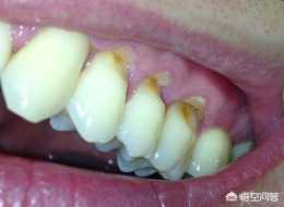 牙齒接近牙齦處有個小坑，是蛀牙嗎？應該怎麼處理？